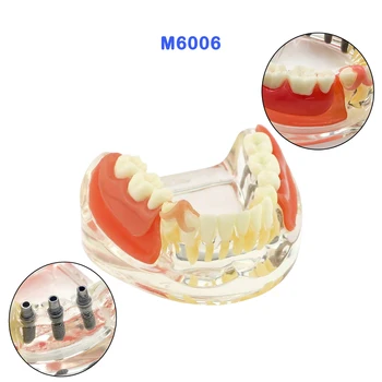 Модель зубов для реставрации имплантатов Модель зубов Со съемным мостовидным протезом на 3 единицы Для стоматологического имплантологического лечения Демонстрационный режим смол